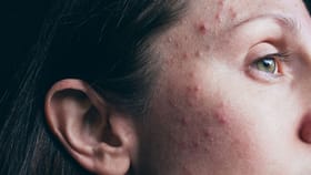 മുഖക്കുരുവിന് പിന്നിലെ വില്ലൻ ഈ ഭക്ഷണങ്ങളാണ്; ഒഴിവാക്കിയാൽ ചർമ്മം