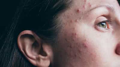 Acne Free Skin: മുഖക്കുരുവിന് പിന്നിലെ വില്ലൻ ഈ ഭക്ഷണങ്ങളാണ്; ഒഴിവാക്കിയാൽ ചർമ്മം തിളങ്ങും