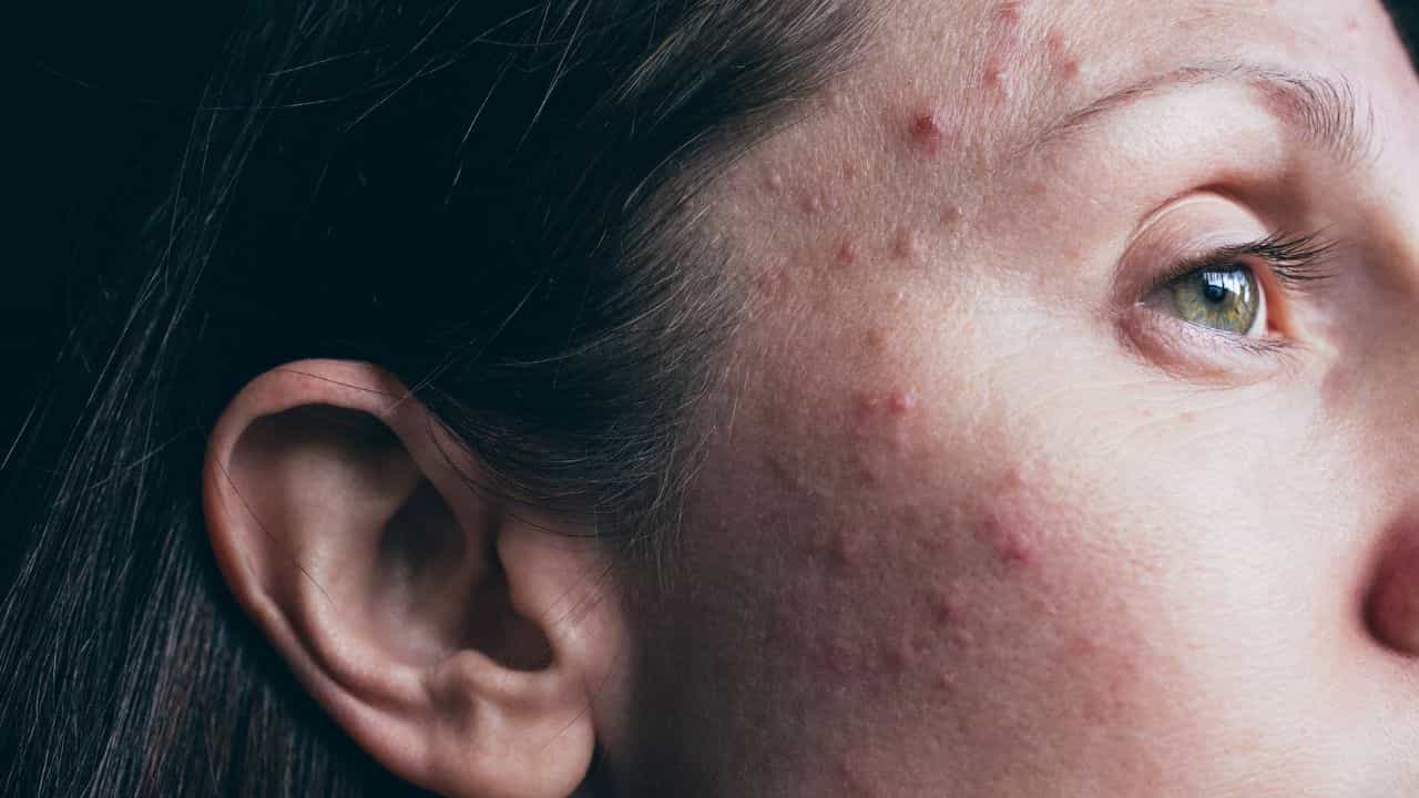 Acne Free Skin: മുഖക്കുരുവിന് പിന്നിലെ വില്ലൻ ഈ ഭക്ഷണങ്ങളാണ്; ഒഴിവാക്കിയാൽ ചർമ്മം തിളങ്ങും Acne Free Skin: മുഖക്കുരുവിന് പിന്നിലെ വില്ലൻ ഈ ഭക്ഷണങ്ങളാണ്; ഒഴിവാക്കിയാൽ ചർമ്മം തിളങ്ങും