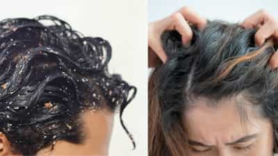 Dandruff Treatment: താരൻ എല്ലാം ഒന്നാണെന്ന് കരുതല്ലേ! പണി കിട്ടുന്നതിന് മുൻപ് തിരിച്ചറിയണം; ഓരോന്നിനും പരിഹാരം വെവ്വേറെ