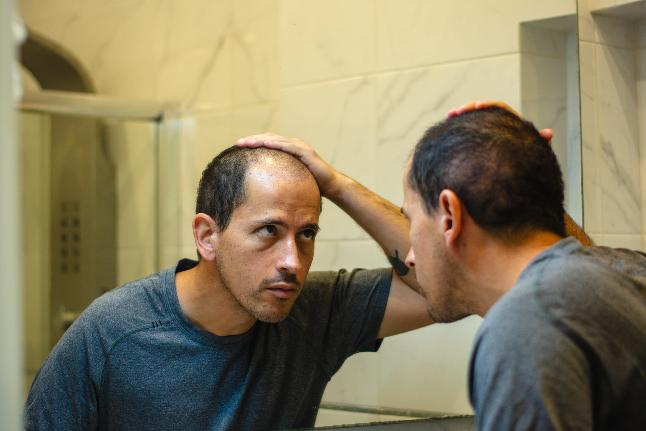 പാരമ്പര്യമായിട്ടുള്ള മുടി കൊഴിച്ചിൽ പൂർണ്ണമായും തടയാൻ കഴിയില്ല. എന്നാൽ തുടക്കത്തിലേ കാരണം കണ്ടെത്തി ചികിത്സിച്ചാൽ മുടി കൊഴിച്ചിലിന്റെ വേഗത കുറയ്ക്കാൻ സാധിക്കും. രണ്ടാമത്തേത് മാനസിക സമ്മർദ്ദം മൂലമുള്ള മുടി കൊഴിച്ചിലാണ്. കുളിക്കുമ്പോഴോ മുടി ചീവുമ്പോഴോ ഒരുപാട് മുടി കൊഴിയുന്നതാണ് പ്രധാന ലക്ഷണം. തലയുടെ ഒരു ഭാഗത്ത് മാത്രം ഒതുങ്ങാതെ മൊത്തതിൽ മുടി കുറയുന്ന അവസ്ഥ.
