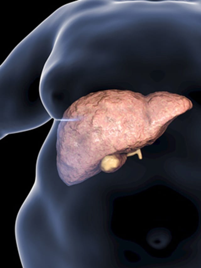 ഫാറ്റി ലിവറിനെ തുരത്തണോ? ഈ ഭക്ഷണങ്ങള്‍ ഒഴിവാക്കിക്കോ