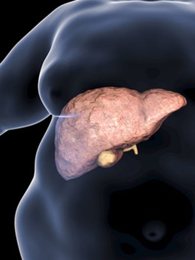 ഫാറ്റി ലിവറിനെ തുരത്തണോ? ഈ ഭക്ഷണങ്ങള്‍ ഒഴിവാക്കിക്കോ