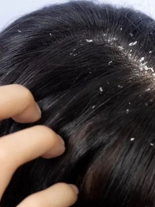 താരന്‍ മാറ്റാന്‍ ഇതൊന്നു കഴിച്ചു നോക്കൂ