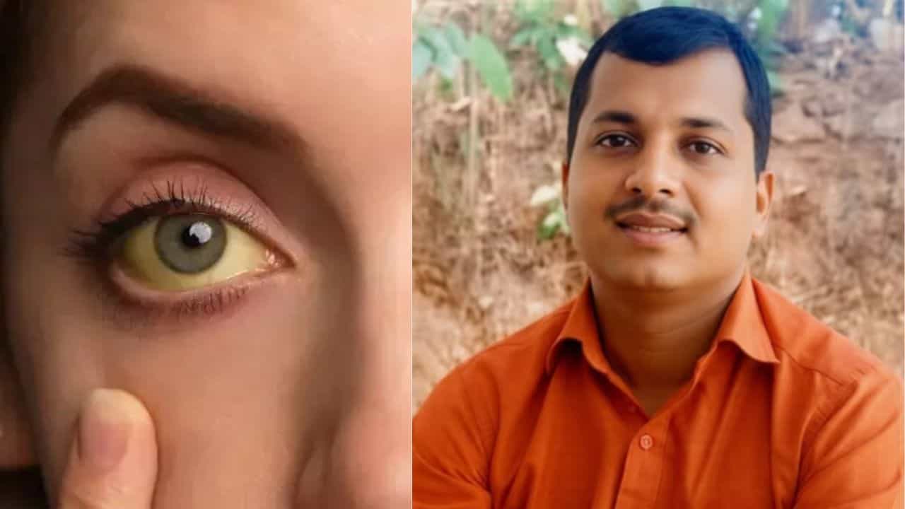 Kozhikode Jaundice Death: ആശങ്കയിൽ കോഴിക്കോട്; മഞ്ഞപ്പിത്തം ബാധിച്ച് യുവാവ് മരിച്ചു, നിസാരമല്ല ജാ​ഗ്രതവേണം