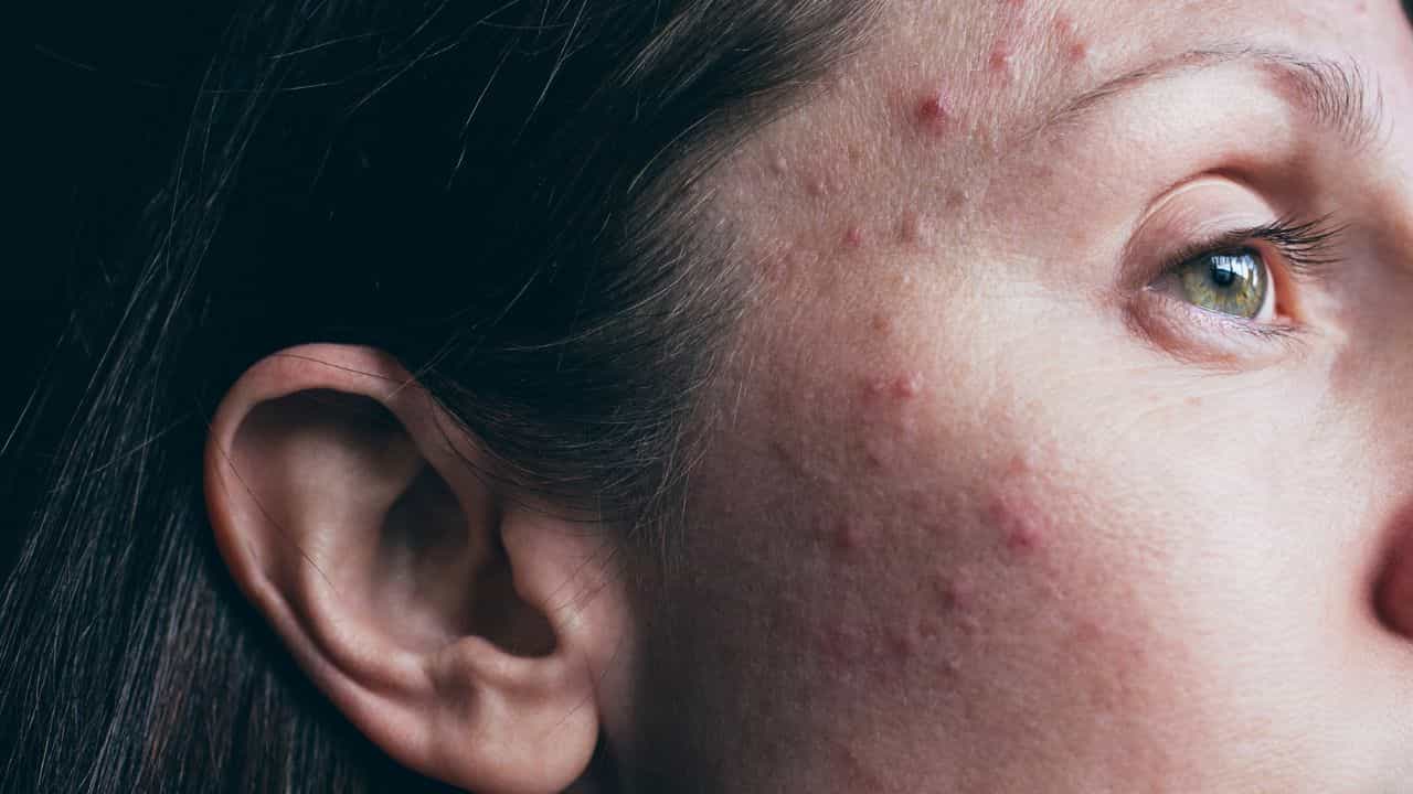 Summer Health Issues: വിയർപ്പും കുരുക്കളും ചൂട് മാത്രം കൊണ്ടല്ല, അധികം ശ്രദ്ധിക്കാതെ പോകുന്നൊരു രോഗം പിന്നിൽ