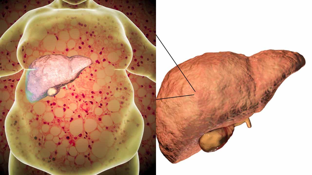Fatty Liver: മദ്യം തൊടാത്തവർക്കും ഫാറ്റി ലിവറോ? ഈ കാരണങ്ങൾ നിങ്ങളെ ഞെട്ടിക്കും