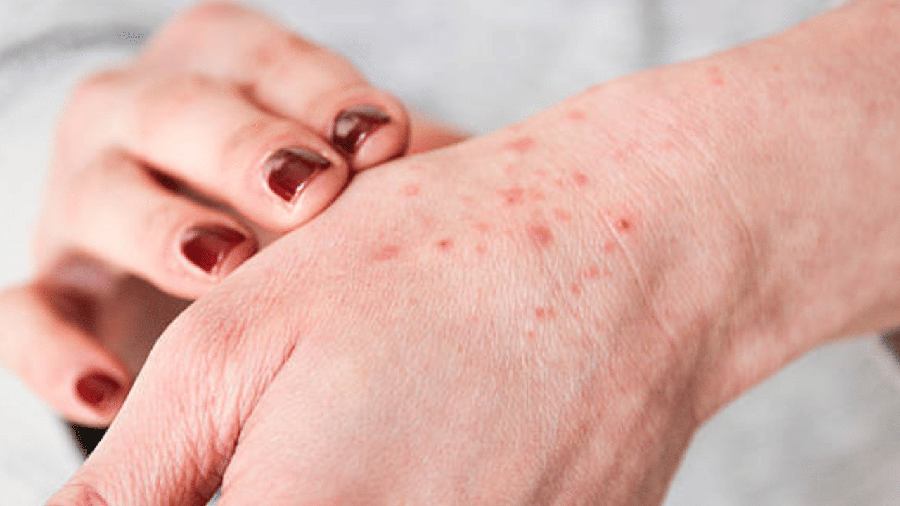 ചൂട് കൂടുന്നതോടെ കൊച്ചുകുട്ടികൾ ഉൾപ്പെടെയുള്ളവർ ചൂടുകുരുവിനാൽ വലയുകയാണ്. ഇവയെ പ്രതിരോധിക്കാൻ എന്താണ് വഴി? ചൂടുകുരു ശമിക്കാൻ വീട്ടിലിരുന്ന് ചെയ്യാവുന്ന ചില കാര്യങ്ങൾ അറിഞ്ഞാലോ. ( Image Credit Source: Getty Image )
