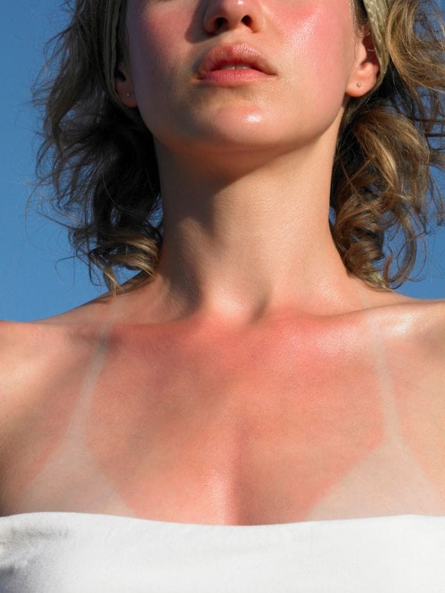 ചൂടുകുരു അലട്ടുന്നുണ്ടോ? വീട്ടിലുണ്ട് പരിഹാരം