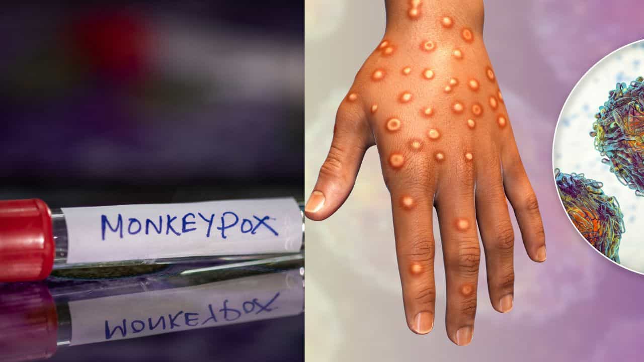 Monkey Pox: സാധാരണ പനിയല്ല, ശരീരത്തിൽ ഈ മാറ്റങ്ങൾ ശ്രദ്ധിക്കണം; കുരങ്ങുപനി എങ്ങനെ പകരും, ഈ ലക്ഷണങ്ങൾ അവഗണിക്കരുത്