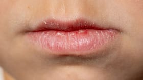 Lips Care: ചുണ്ട് വരണ്ട് പൊട്ടാറുണ്ടോ? പരിഹാരം വീട്ടിൽ തന്നെയുണ്ട്...