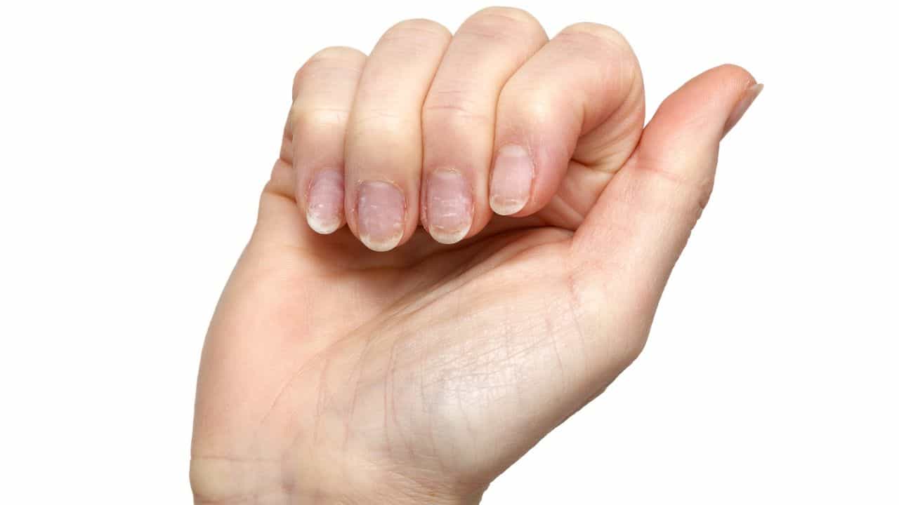 Nail health indicators: നഖം രോഗം പറയും, കാൻസറിന്റെ ലക്ഷണങ്ങൾ പോലും തിരിച്ചറിയാം Nail health indicators: നഖം രോഗം പറയും, കാൻസറിന്റെ ലക്ഷണങ്ങൾ പോലും തിരിച്ചറിയാം