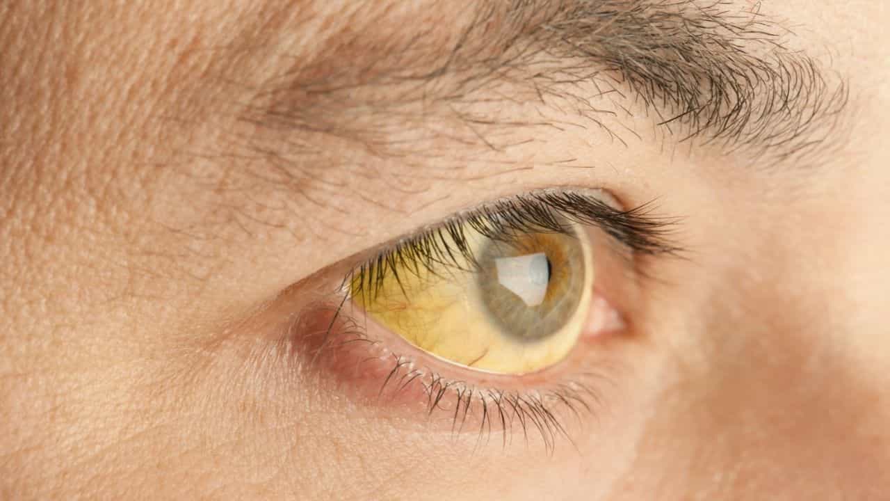 Malappuram Jaundice Outbreak: മഞ്ഞപ്പിത്ത ഭീതിയിൽ മലപ്പുറം വണ്ടൂർ: ബാധിതർ നൂറു കടന്നു, ഒരു മരണം Malappuram Jaundice Outbreak: മഞ്ഞപ്പിത്ത ഭീതിയിൽ മലപ്പുറം വണ്ടൂർ: ബാധിതർ നൂറു കടന്നു, ഒരു മരണം